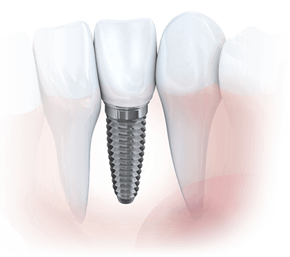 Dental Implants